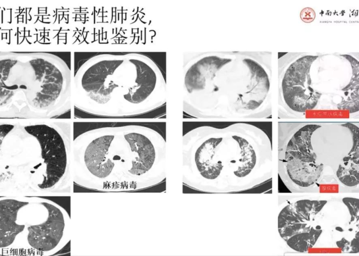 丁香园新冠疫情通报（丁香园 新冠疫情）