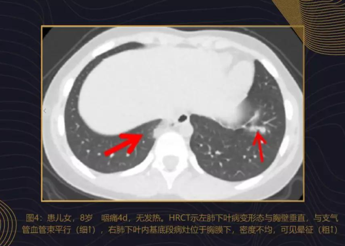 实时更新|新冠肺炎疫情地图（实时更新新型冠状病毒肺炎疫情地图一一）